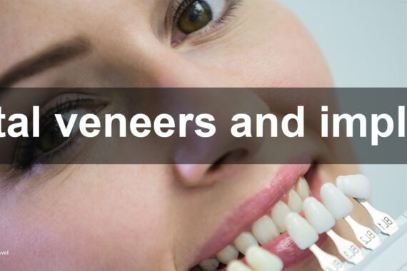 Dental veneers and implants