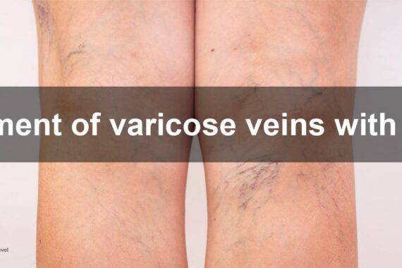 Treatment of varicose veins with EVLA