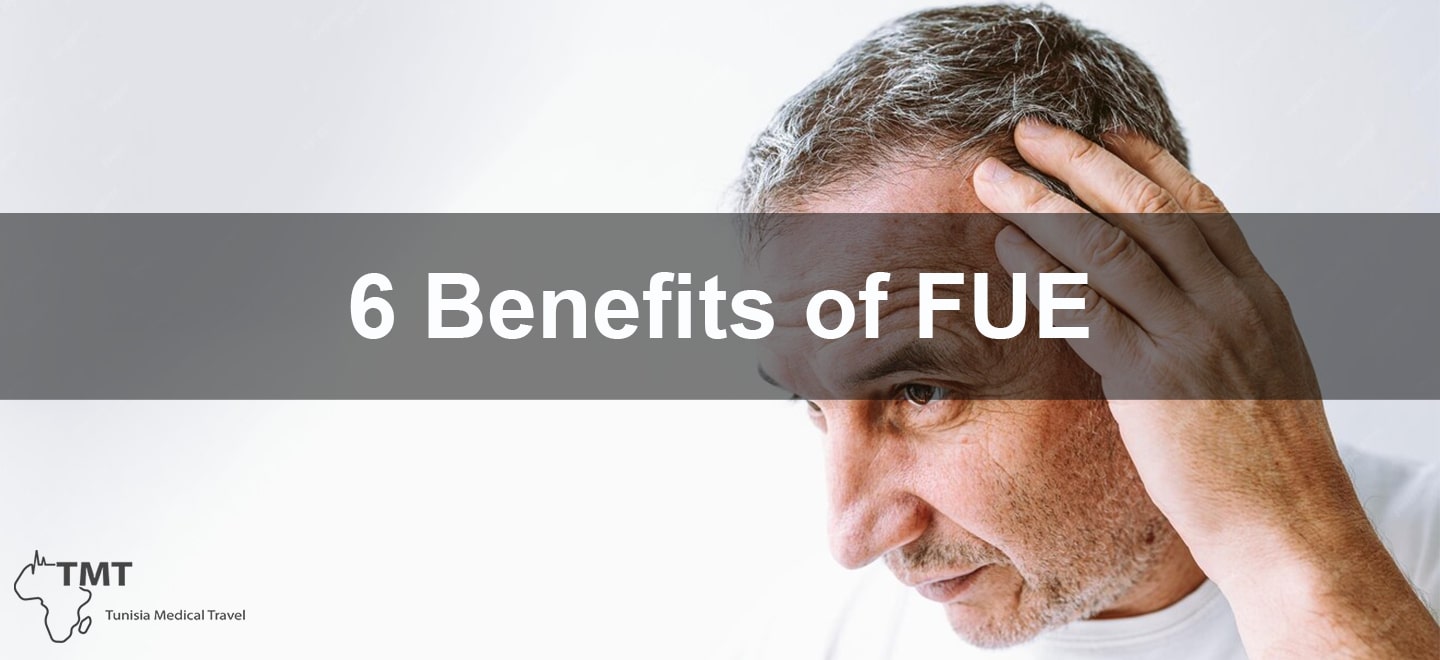 Benefits of FUE