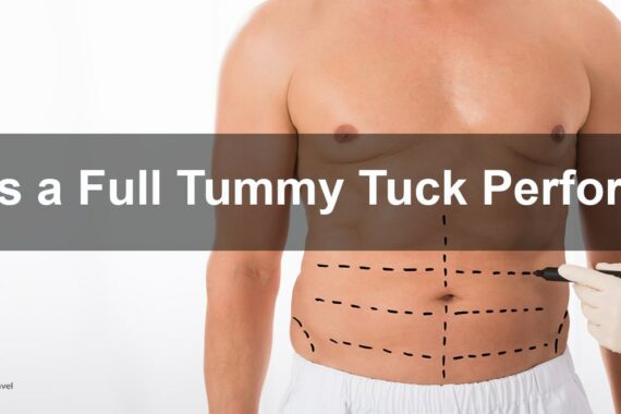 Full tummy tuck