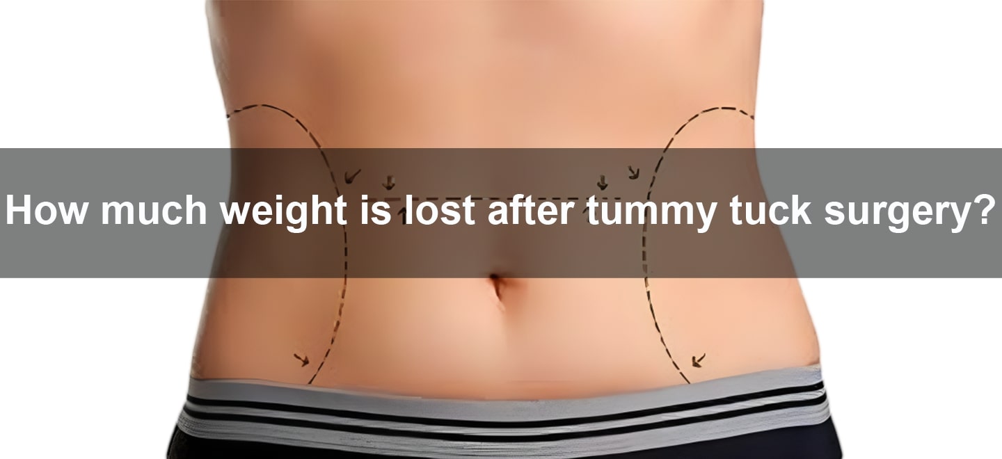 Weight loss tummy tuck