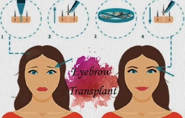 eyebrow transplantation