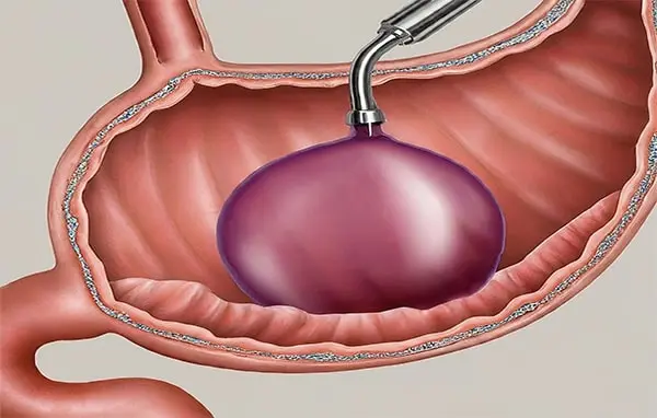 Gastric Balloons