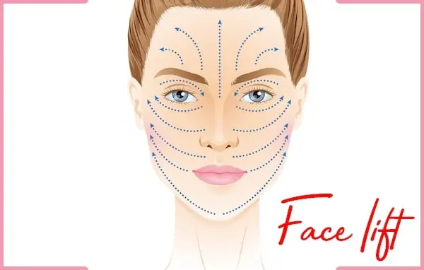 facelifts