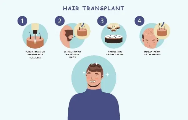 a hair transplant