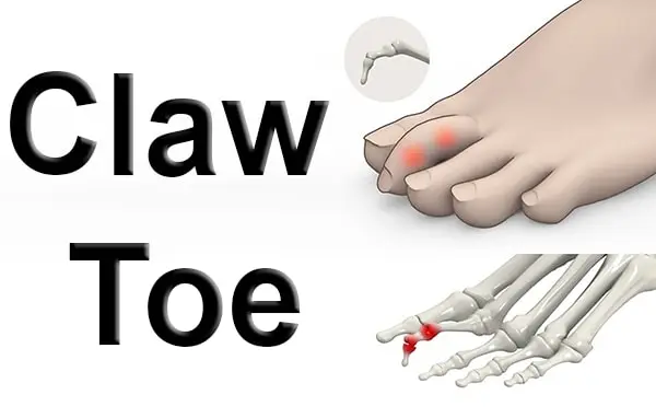 Claw Toes
