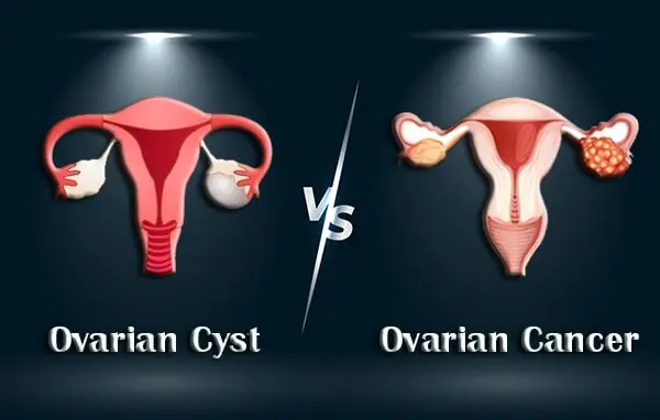 Ovarian Cysts vs. Cancer