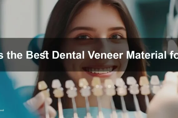 A dental veneer