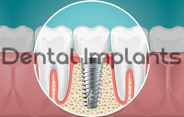 A dental implants