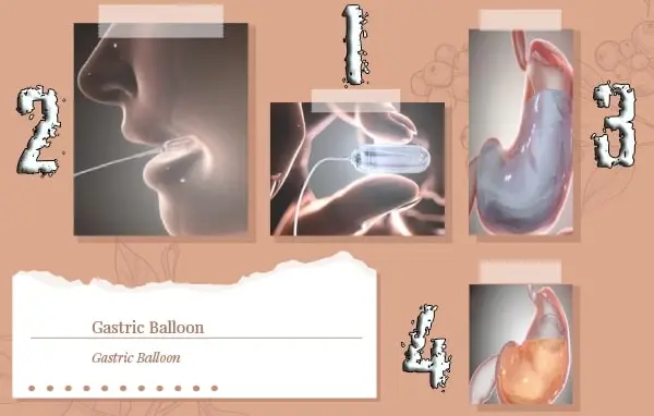 Gastric Balloon