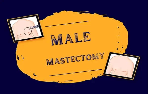 male mastectomy